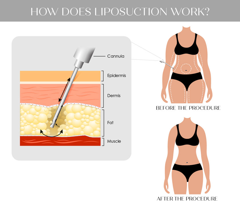 İstanbul liposuction - Fidel Clinic