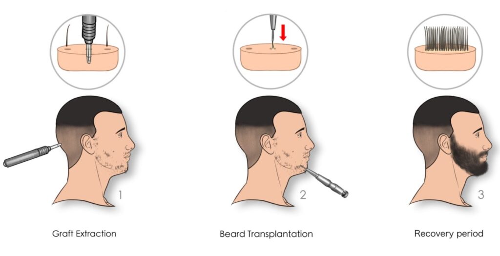 Beard Transplants