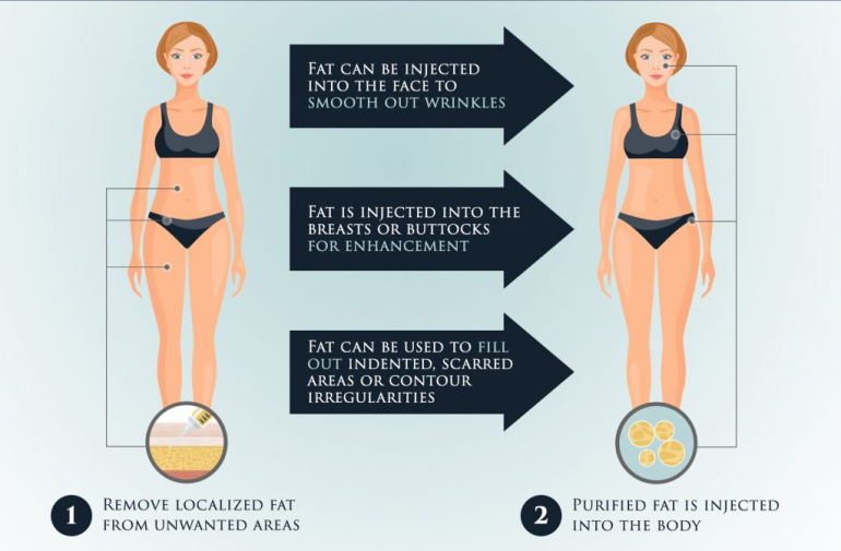 Fat transfer near me