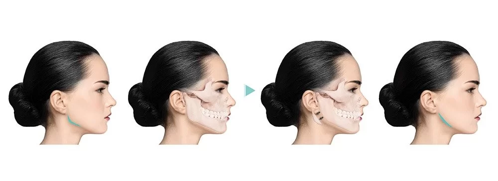 chin reduction - Fidel Clinic