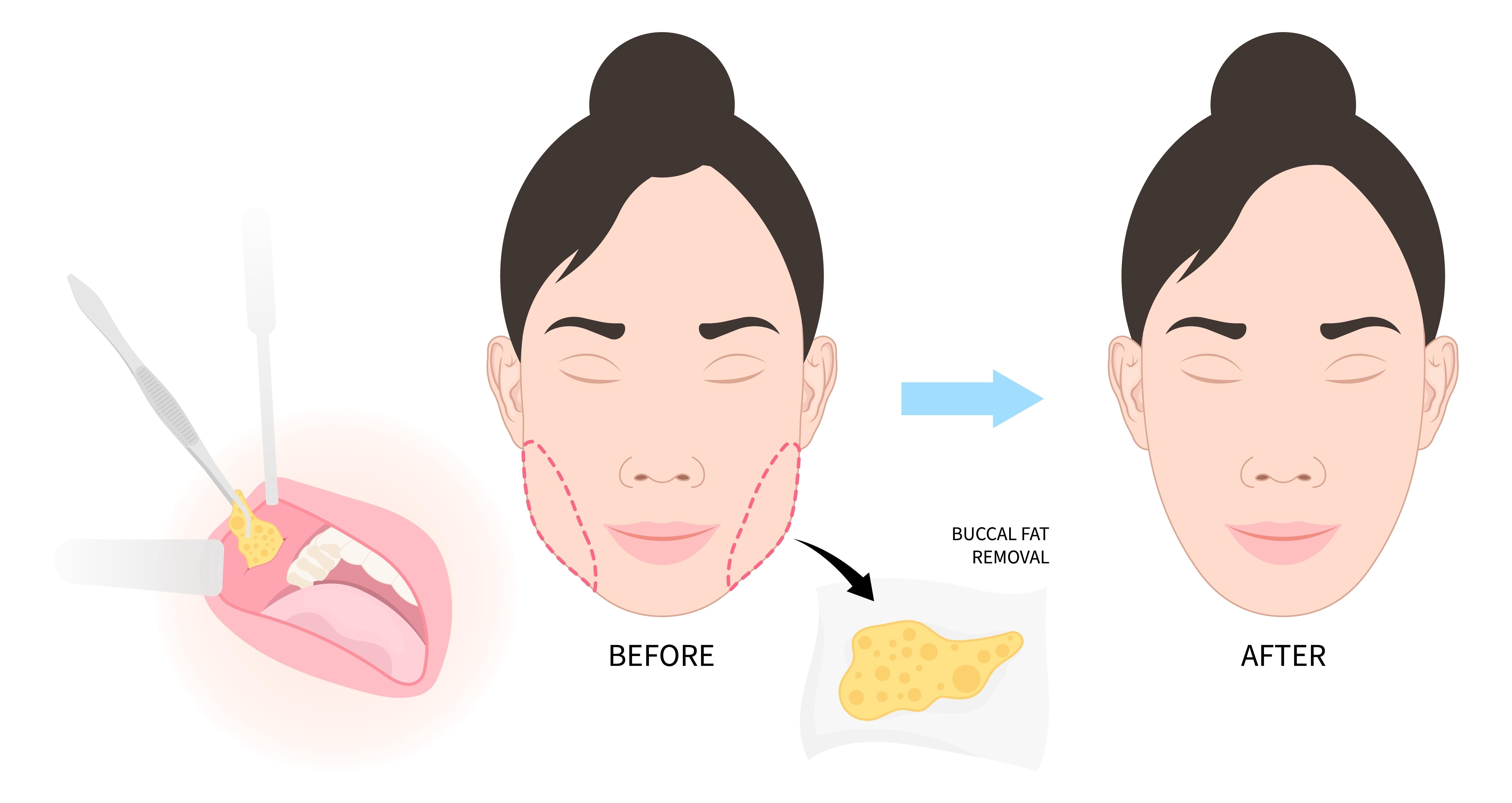 (Buccal Fat Removal)- Bichectomy