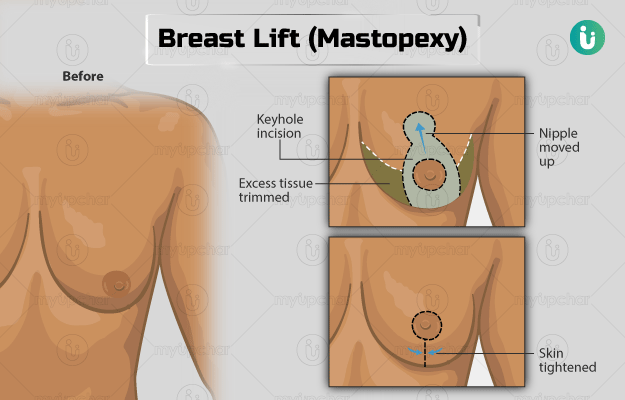 Mastopexy - Breast Lift