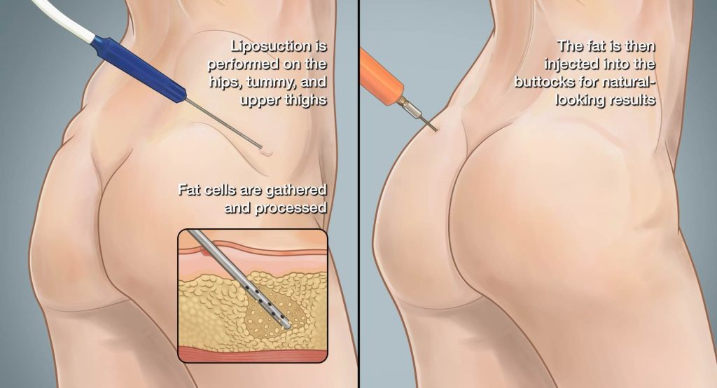 Braziliyalik dumba Braziliyalik dumba