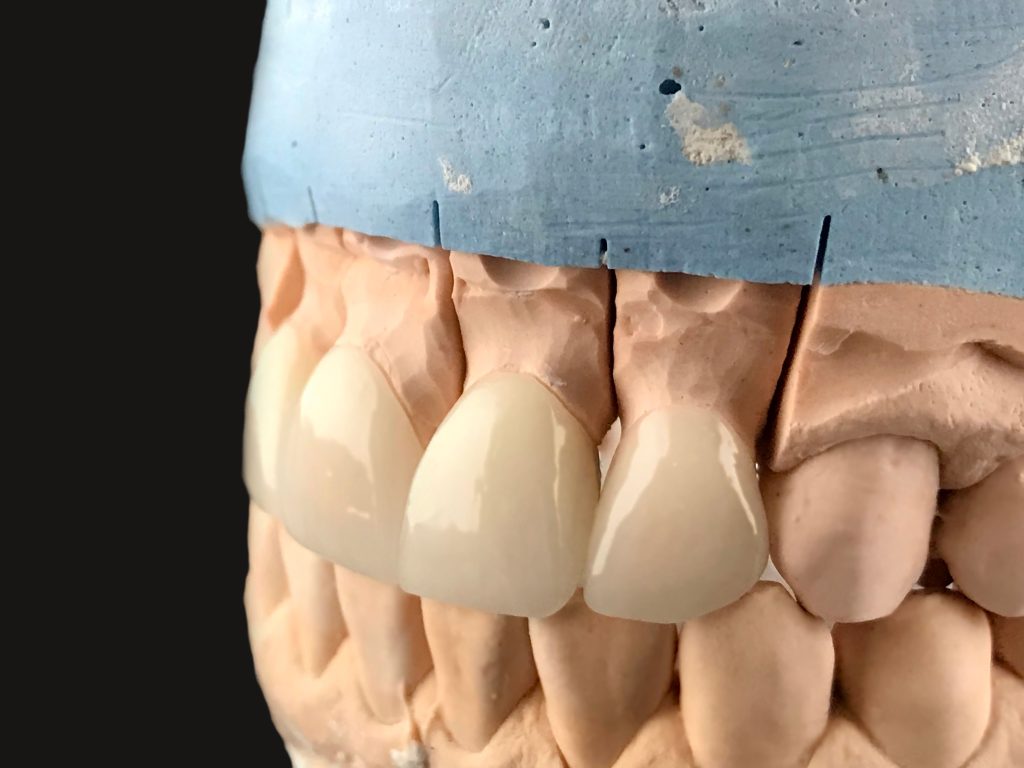 hollywood smile - Fidel Clinic - Dental