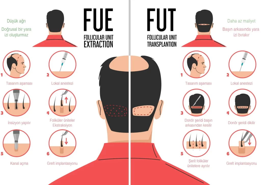 Hair transplantation türkey- Fidel Clinic